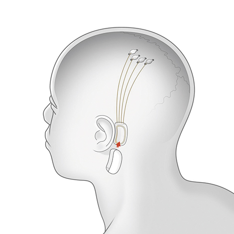 ESPECIALES | MICROCHIP CEREBRAL ESPECIALES | MICROCHIP CEREBRAL